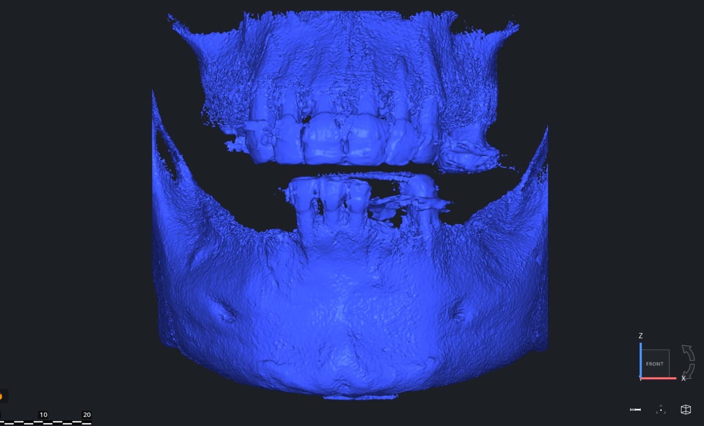 Reconstruction 3D d'un CBCT montrant les deux maxillaires